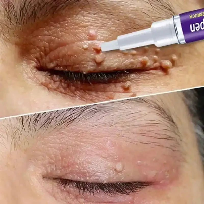 Eelhoe Wart Removing Pen